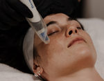 March Offer | Dermapen Skin Needling: Purchase 4 Treatments, Receive the 5th Free